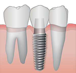 Implant-service
