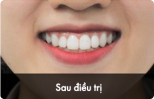 hieu_qua_sau_1.png