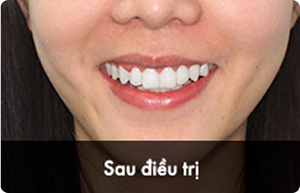 hieu_qua_sau_2.png