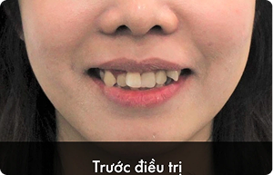 hieu_qua_truoc_2.png