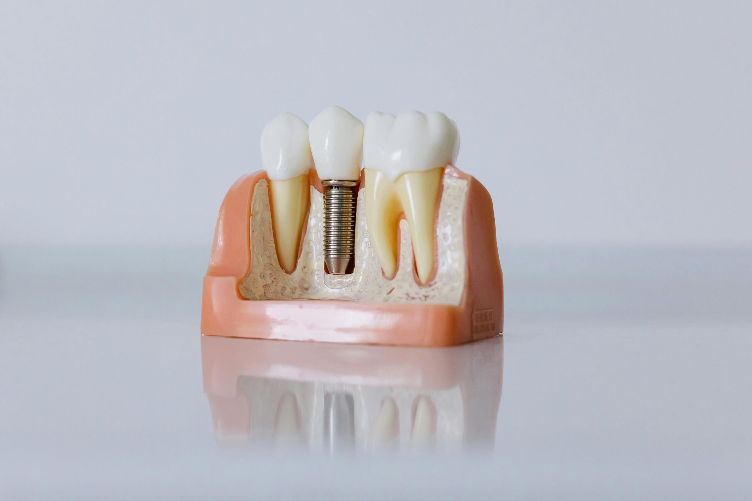 implant1-2