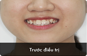 hieu_qua_truoc_1